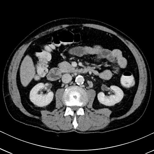 Chronic appendicitis complicated by appendicular abscess, pylephlebitis and liver abscess (Radiopaedia 54483-60700 B 72).jpg