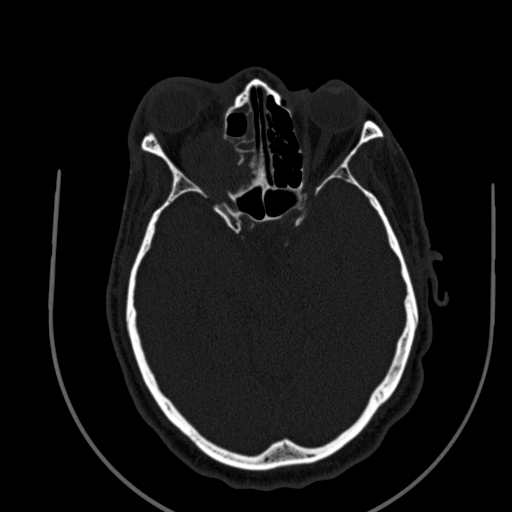 Chronic invasive fungal sinusitis (Radiopaedia 91563-109286 Axial sinus 92).jpg