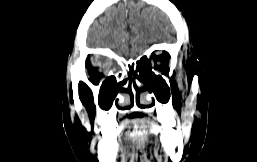 Chronic invasive fungal sinusitis (Radiopaedia 91563-109286 D 36).jpg