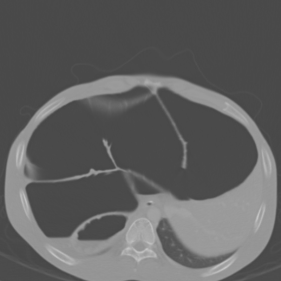 Chronic large bowel pseudo-obstruction (Radiopaedia 43181-46492 Axial bone window 43).jpg
