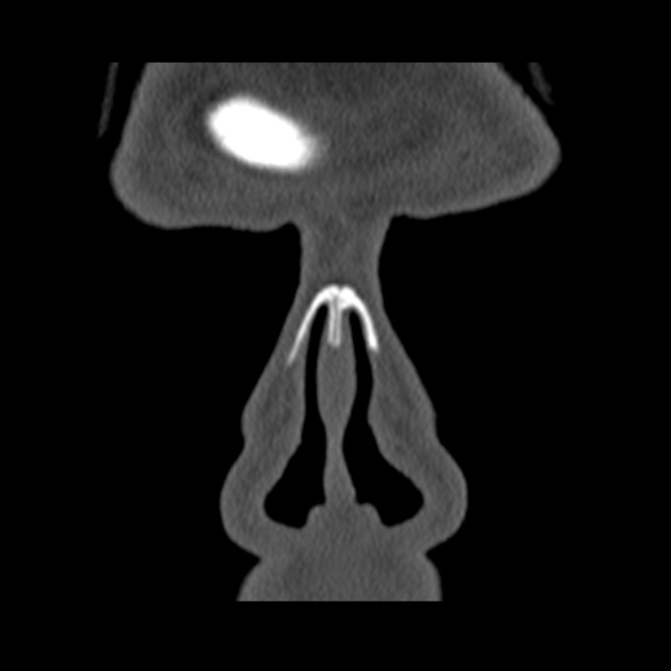Chronic maxillary sinusitis (Radiopaedia 27879-28116 Coronal bone window 3).jpg