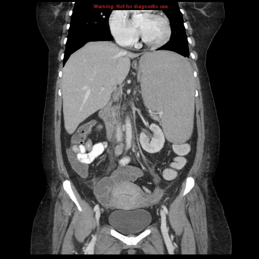 File:Chronic myeloid leukemia with splenic infarction (Radiopaedia 9178-9874 E 31).jpg