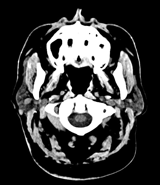File:Chronic osteomyelitis - calvarial (severe) (Radiopaedia 69668-79616 Axial non-contrast 20).jpg