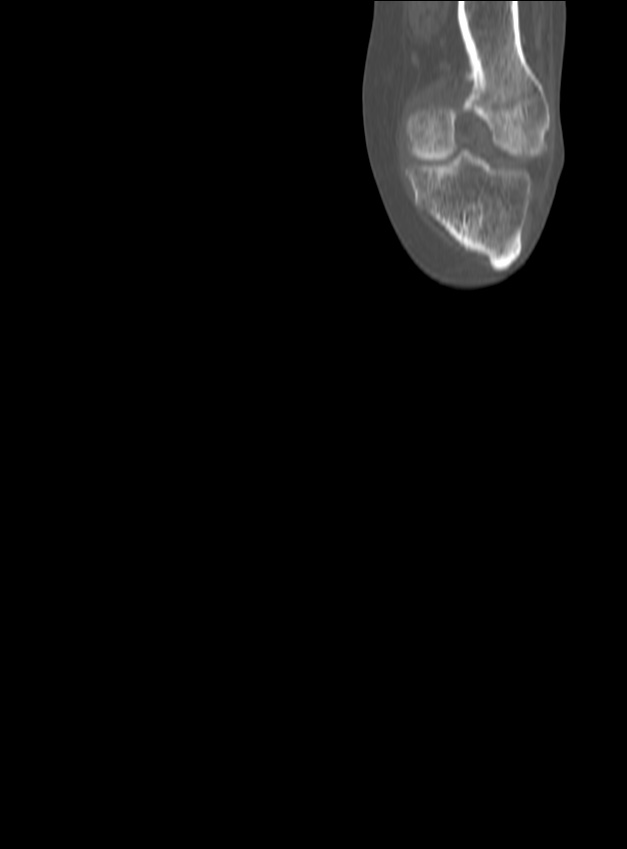 Chronic osteomyelitis - tibia (with sequestrum) (Radiopaedia 73273-84090 Coronal non-contrast 4).jpg