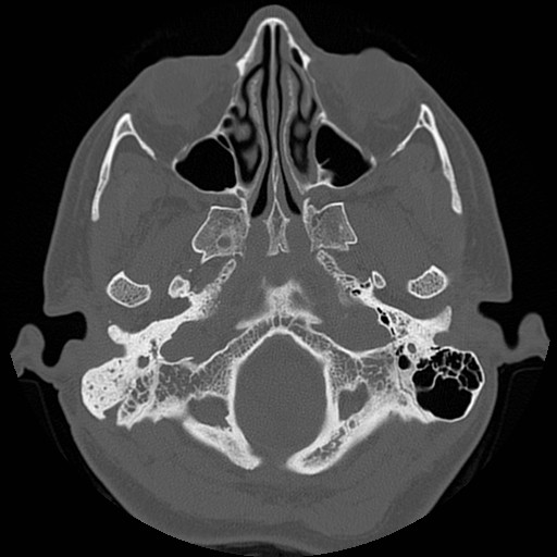 File:Chronic otomastoiditis (Radiopaedia 27138-27309 Axial bone window 9).jpg