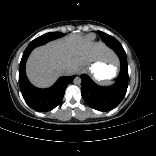 Chronic pancreatitis (Radiopaedia 64576-73450 Axial non-contrast 8).jpg