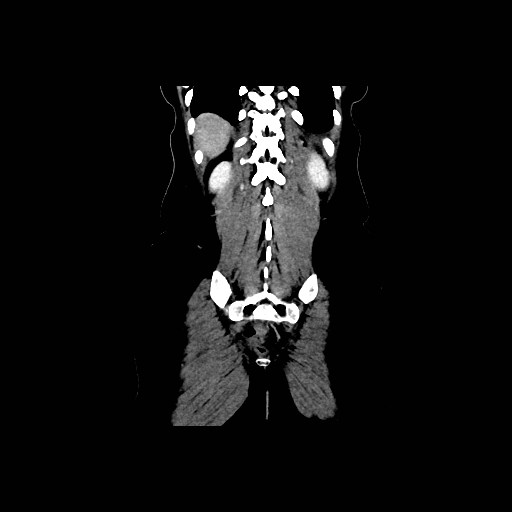 Chronic portal venous thrombosis with cavernous transformation (Radiopaedia 73618-84398 B 88).jpg