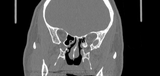 Chronic sphenoidal sinusitis (Radiopaedia 62030-70122 Coronal bone window 93).jpg