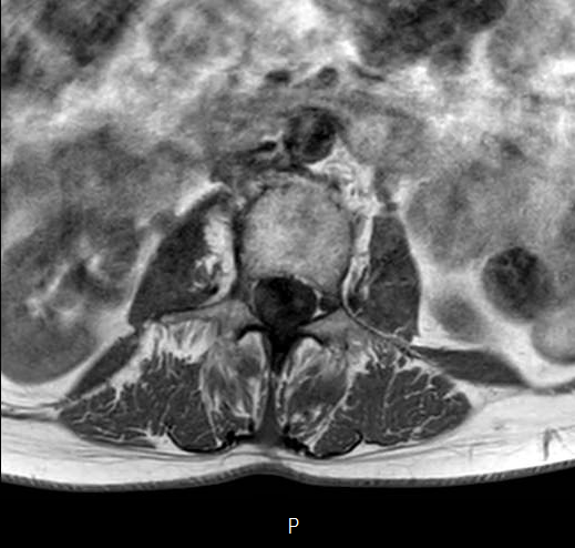 File:Chronic spinal hematoma with cauda equina syndrome (Radiopaedia 75745-87090 Axial T1 11).png