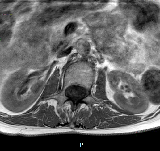 File:Chronic spinal hematoma with cauda equina syndrome (Radiopaedia 75745-87090 Axial T1 4).png