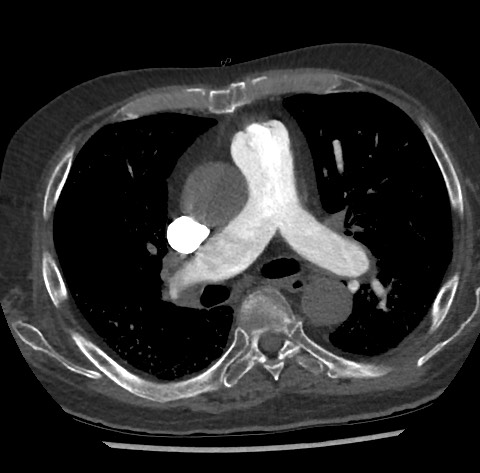 File:Chronic thromboembolic pulmonary disease (Radiopaedia 90694-108119 Axial C+ CTPA 45).jpg
