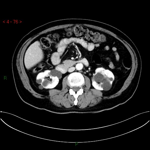 File:Circumaortic left renal vein and doubled left renal arteries (Radiopaedia 52268-58158 B 36).jpg