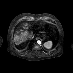 Cirrhosis and hepatocellular carcinoma in the setting of hemochromatosis (Radiopaedia 75394-86594 Axial T1 C+ fat sat 150).jpg