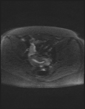 Class II Mullerian duct anomaly- unicornuate uterus with rudimentary horn and non-communicating cavity (Radiopaedia 39441-41755 Axial DWI 47).jpg
