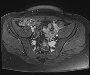 File:Class II Mullerian duct anomaly- unicornuate uterus with rudimentary horn and non-communicating cavity (Radiopaedia 39441-41755 Axial T1 fat sat 32).jpg