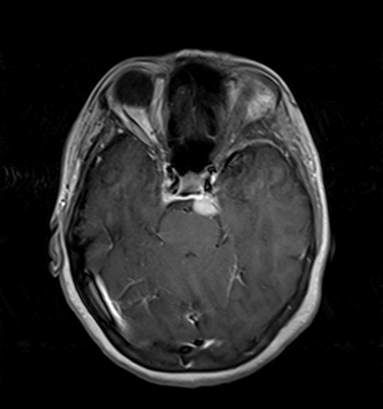 File:Clival meningioma (Radiopaedia 53278-59248 Axial T1 C+ 7).jpg