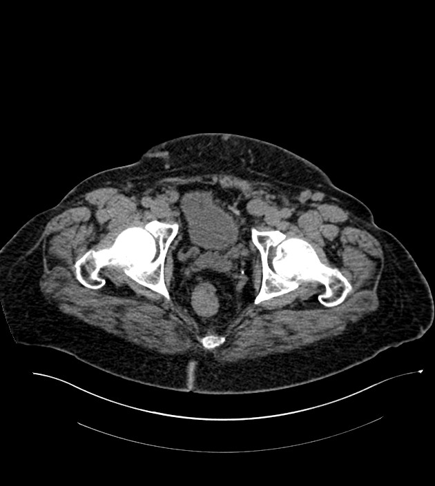 Closed-loop small bowel obstruction-internal hernia (Radiopaedia 78439-91096 Axial non-contrast 147).jpg