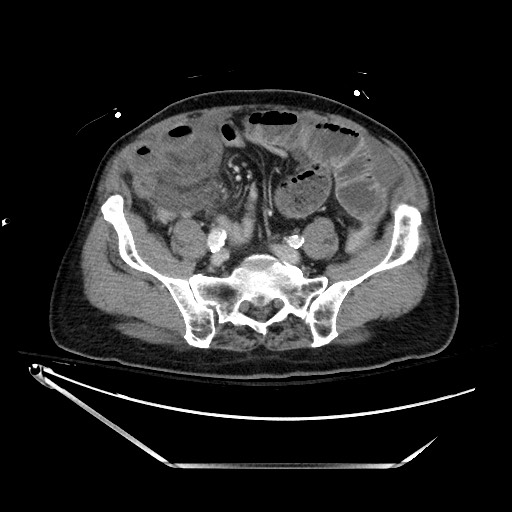 Closed loop obstruction due to adhesive band, resulting in small bowel ischemia and resection (Radiopaedia 83835-99023 D 110).jpg