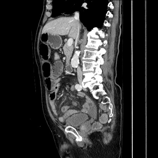 Closed loop obstruction due to adhesive band, resulting in small bowel ischemia and resection (Radiopaedia 83835-99023 F 87).jpg