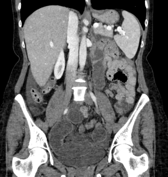 Closed loop small bowel obstruction (Radiopaedia 71211-81508 B 64).jpg