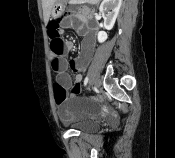 Closed loop small bowel obstruction (Radiopaedia 71211-81508 C 105).jpg