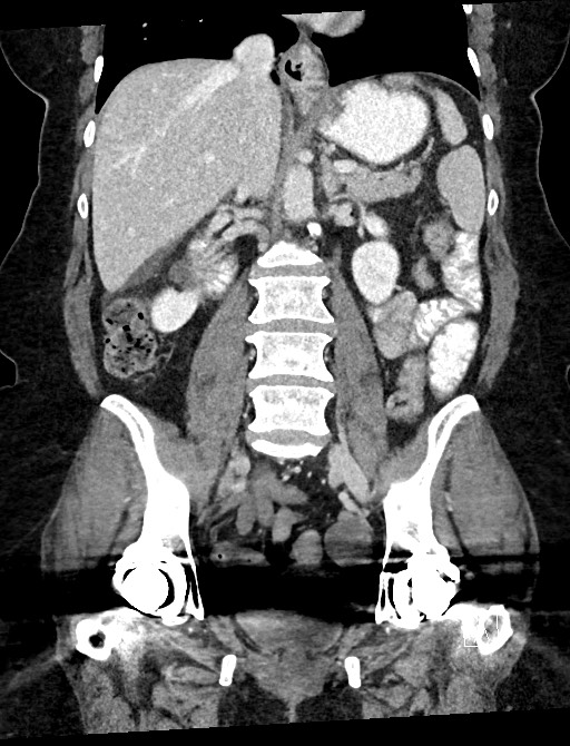 Closed loop small bowel obstruction - adhesions (Radiopaedia 59078-66369 B 71).jpg