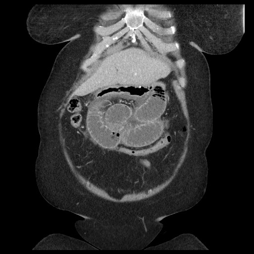 Closed loop small bowel obstruction - internal hernia (Radiopaedia 65402-74450 B 24).jpg