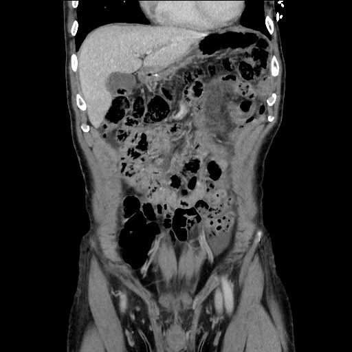 File:Closed loop small bowel obstruction - omental adhesion causing "internal hernia" (Radiopaedia 85129-100682 B 42).jpg