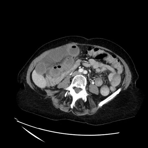 File:Closed loop small bowel obstruction due to adhesive band, with intramural hemorrhage and ischemia (Radiopaedia 83831-99017 Axial 2).jpg