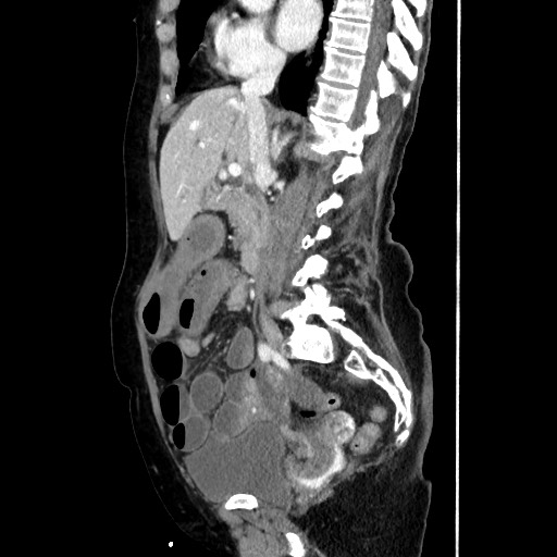 File:Closed loop small bowel obstruction due to adhesive band, with intramural hemorrhage and ischemia (Radiopaedia 83831-99017 D 93).jpg