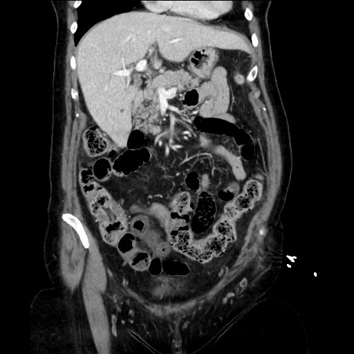 Closed loop small bowel obstruction due to adhesive bands - early and late images (Radiopaedia 83830-99014 B 46).jpg