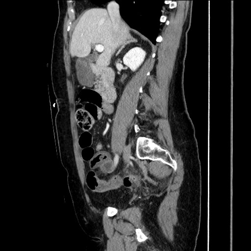 Closed loop small bowel obstruction due to adhesive bands - early and late images (Radiopaedia 83830-99014 C 75).jpg