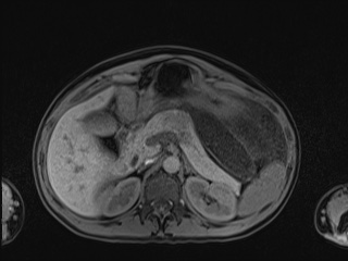 Closed loop small bowel obstruction in pregnancy (MRI) (Radiopaedia 87637-104031 Axial T1 fat sat 38).jpg