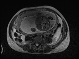 Closed loop small bowel obstruction in pregnancy (MRI) (Radiopaedia 87637-104031 D 11).jpg