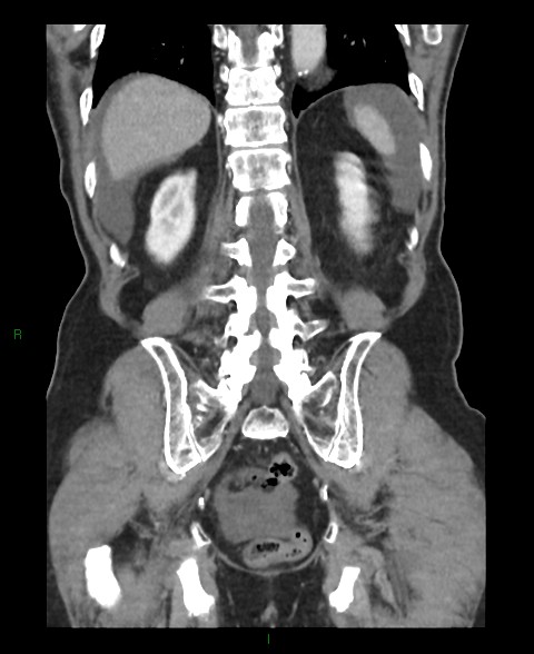 Closed loop small bowel obstruction with ischemia (Radiopaedia 84180-99456 B 14).jpg