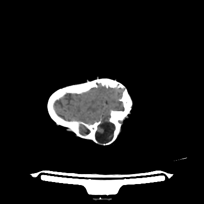 File:Cloverleaf skull (Radiopaedia 91901-109710 Axial non-contrast 132).jpg