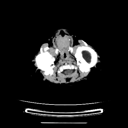 Cloverleaf skull (Radiopaedia 91901-109710 Axial non-contrast 39).jpg