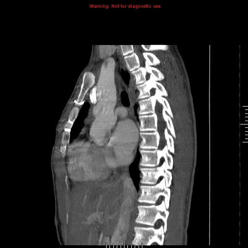 File:Coarctation of the aorta (Radiopaedia 9434-10118 B 24).jpg