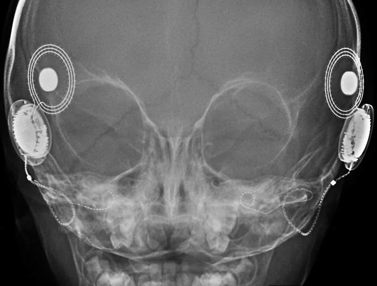 File:Cochlear implant (Radiopaedia 10069).jpg