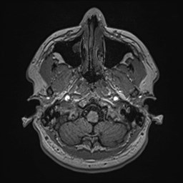 Cochlear incomplete partition type III associated with hypothalamic hamartoma (Radiopaedia 88756-105498 Axial T1 37).jpg