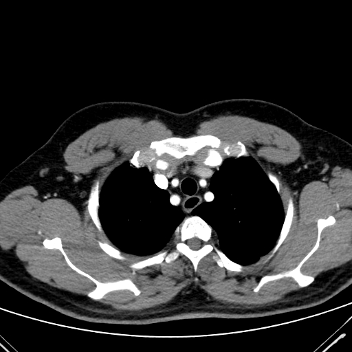 Codominant double aortic arch (Radiopaedia 56012-62637 A 14).jpg