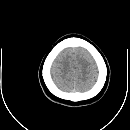 File:Colloid cyst (Radiopaedia 52865-58792 Axial non-contrast 14).jpg