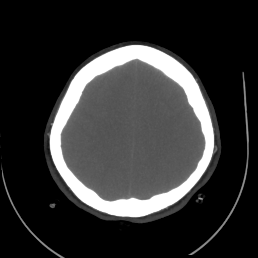 File:Colloid cyst (resulting in death) (Radiopaedia 33423-34499 A 45).png