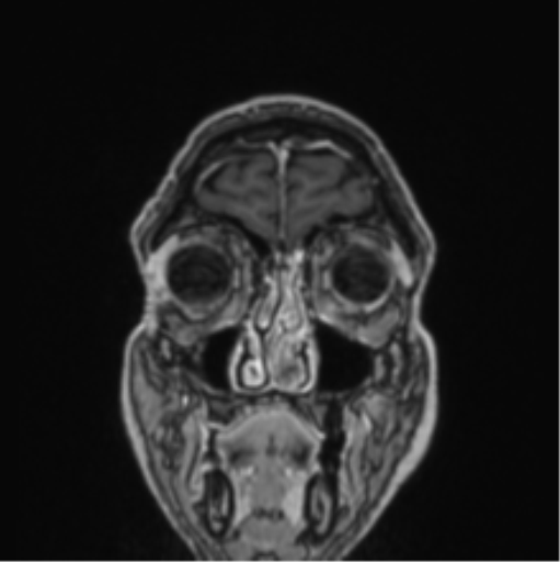 File:Colloid cyst of the third ventricle (Radiopaedia 86571-102662 Coronal T1 C+ 82).png