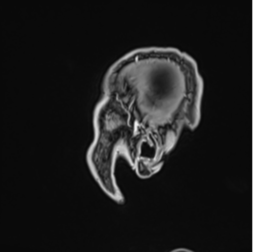 Colloid cyst of the third ventricle (Radiopaedia 86571-102662 Sagittal T1 C+ 5).png