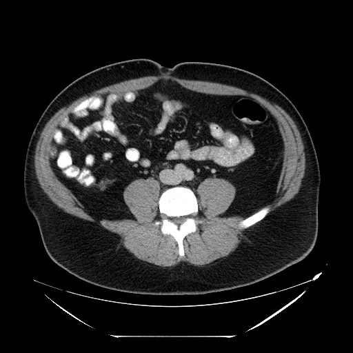 Colocolic intussusception due to lipoma (Radiopaedia 73712-84508 A 73).jpg