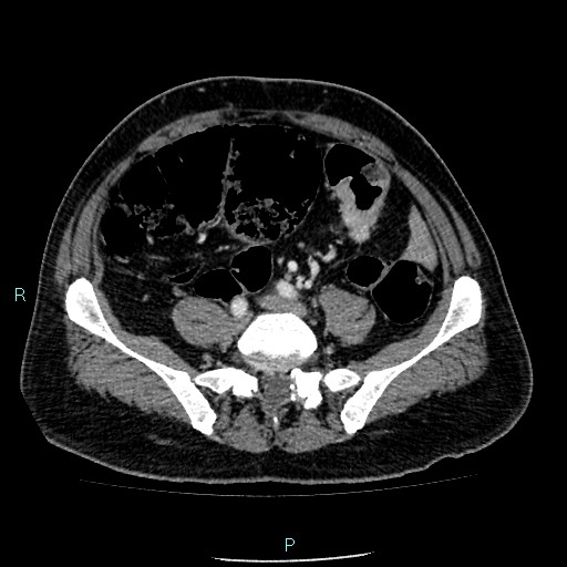 Colon adenocarcinoma with calcific liver metastasis (Radiopaedia 55745-62300 B 31).jpg