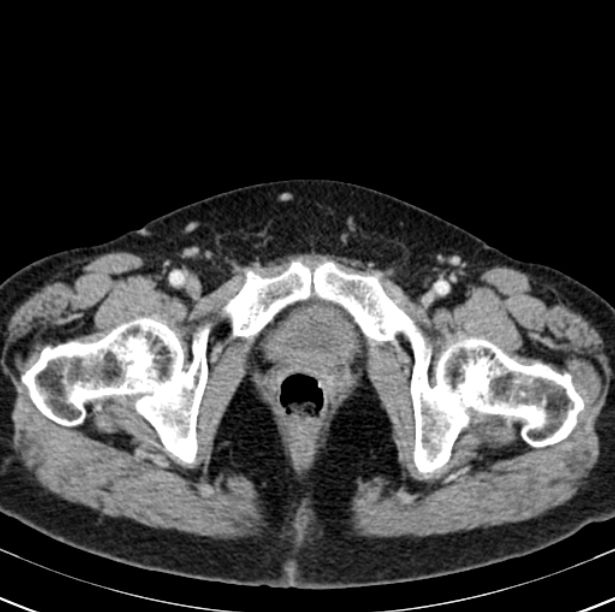 Colon carcinoma with hepatic metastases (Radiopaedia 29477-29961 A 114).jpg