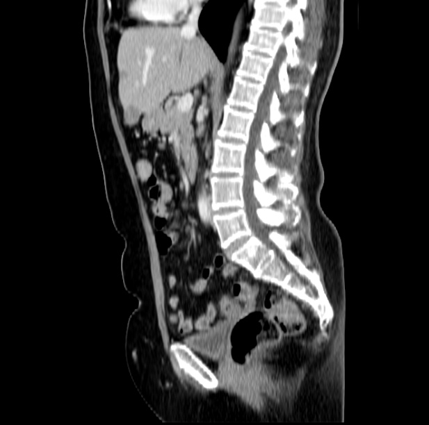 Colon carcinoma with hepatic metastases (Radiopaedia 29477-29961 C 27).jpg