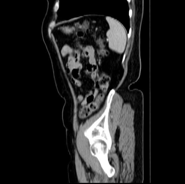 Colon carcinoma with hepatic metastases (Radiopaedia 29477-29961 C 47).jpg